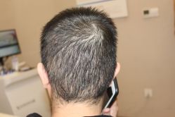 -大麦微针植发丨全国连锁