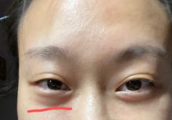 体验后-南京健丽·去眼袋医疗美容机构