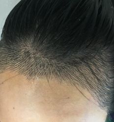 -大麦微针植发全国连锁