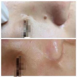 -清疣美疣·痣·斑净肤中心