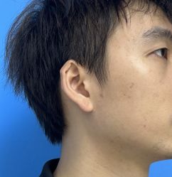 体验前-广西颜白玉医疗美容门诊部