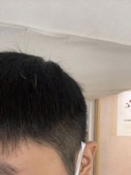 点击看大图 体验后-熙朵美学植发连锁