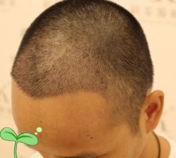 -大麦微针植发丨全国连锁