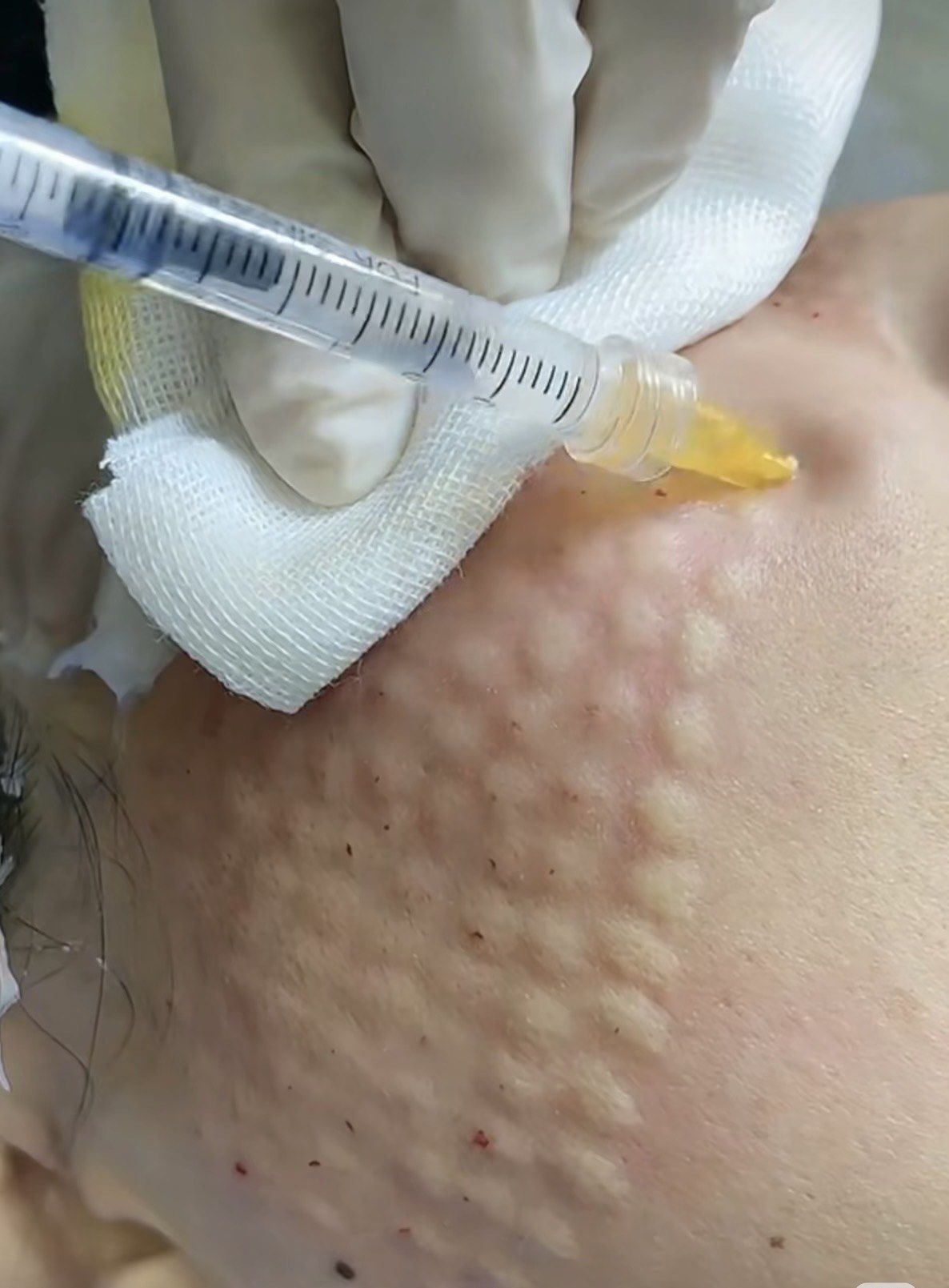 一篇看懂水光针