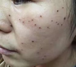 -北京美痣堂古方祛痣斑疣瘊