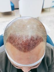 体验后-大麦微针植发全国连锁