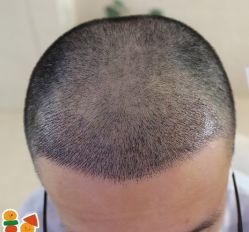 -大麦微针植发丨全国连锁