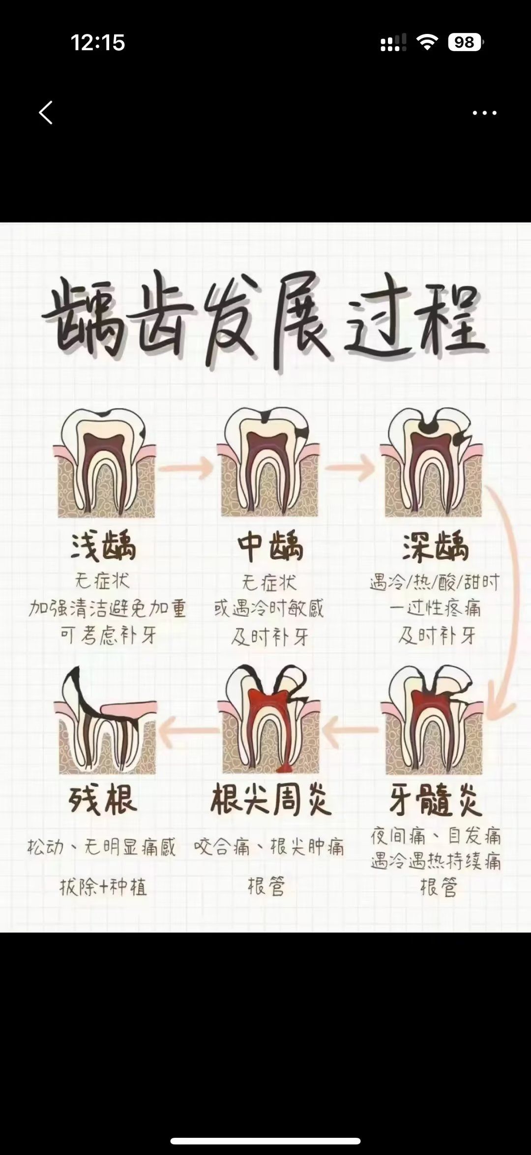 龋齿发展过程