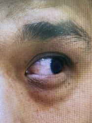 体验后-广州健丽·去眼袋医疗美容机构