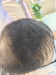 -碧莲盛·不剃发植发