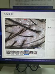 -大麦微针植发丨全国连锁