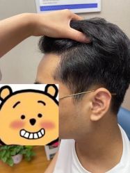 -大麦微针植发全国连锁