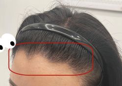 -大麦微针植发全国连锁