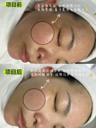 -凡碧诗毛孔清洁收细