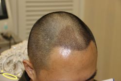 -大麦微针植发丨全国连锁