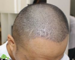 -大麦微针植发丨全国连锁