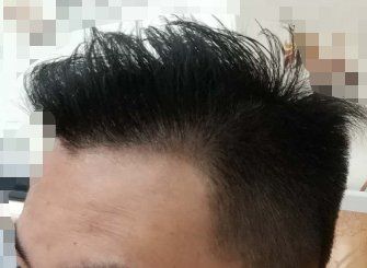 -大麦微针植发全国连锁