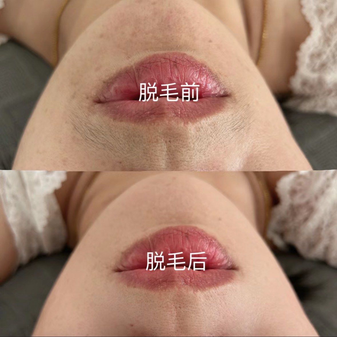 冰点脱毛前后对比