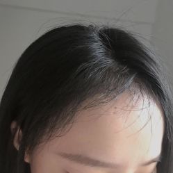 -碧莲盛·不剃发植发