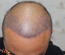 -大麦微针植发丨全国连锁