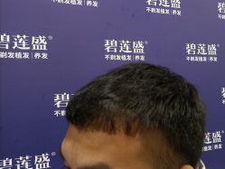 -碧莲盛·不剃发植发