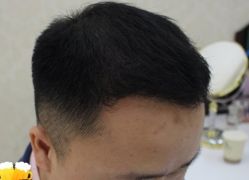 -大麦微针植发丨全国连锁