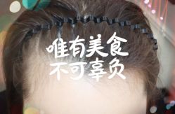 -大麦微针植发全国连锁