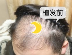 -大麦微针植发全国连锁