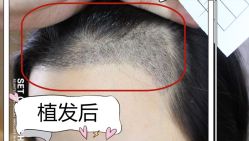 -大麦微针植发全国连锁