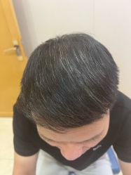-大麦微针植发全国连锁
