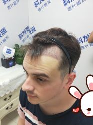 点击看大图 -大麦微针植发丨全国连锁