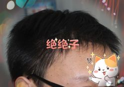 -大麦微针植发全国连锁