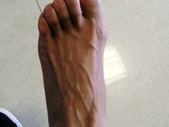 -世龙世家灰指甲鸡眼脚气甲沟炎跖疣护理(通州店)