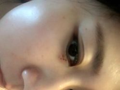 -美丽人生祛斑扁平疣汗管瘤中心