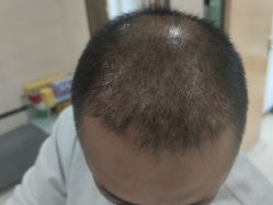 -雍禾植发