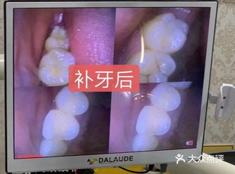 第1：乳牙蛀了要不要治疗? 一定要及时治疗