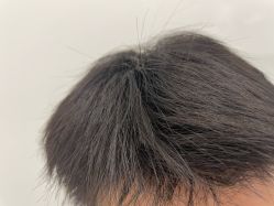 -碧莲盛·不剃发植发