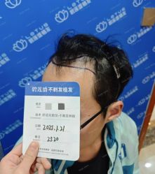 -碧莲盛·不剃发植发