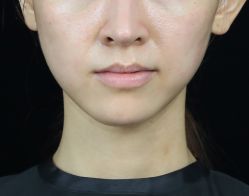 体验前-广州美莱医疗美容医院