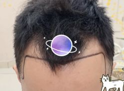 -大麦微针植发全国连锁