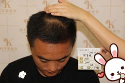 点击看大图 -大麦微针植发丨全国连锁