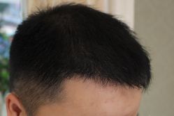 -大麦微针植发全国连锁