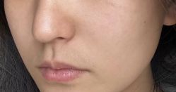 体验后-杭州米兰柏羽医疗美容医院