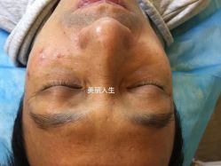 -爱莎扁平疣·汗管瘤·斑痣中心