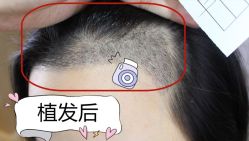 -大麦微针植发全国连锁