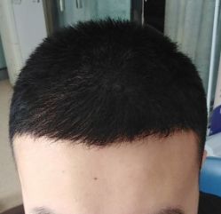 -大麦微针植发全国连锁