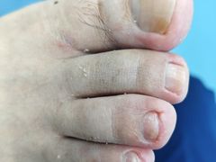 -Andrew指甲专科灰指甲·甲沟炎矫正·3D步态矫形鞋垫定制(浦三路店)