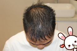 -大麦微针植发丨全国连锁