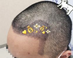 -大麦微针植发全国连锁