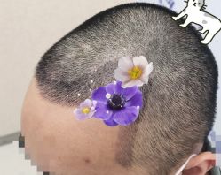 -大麦微针植发全国连锁